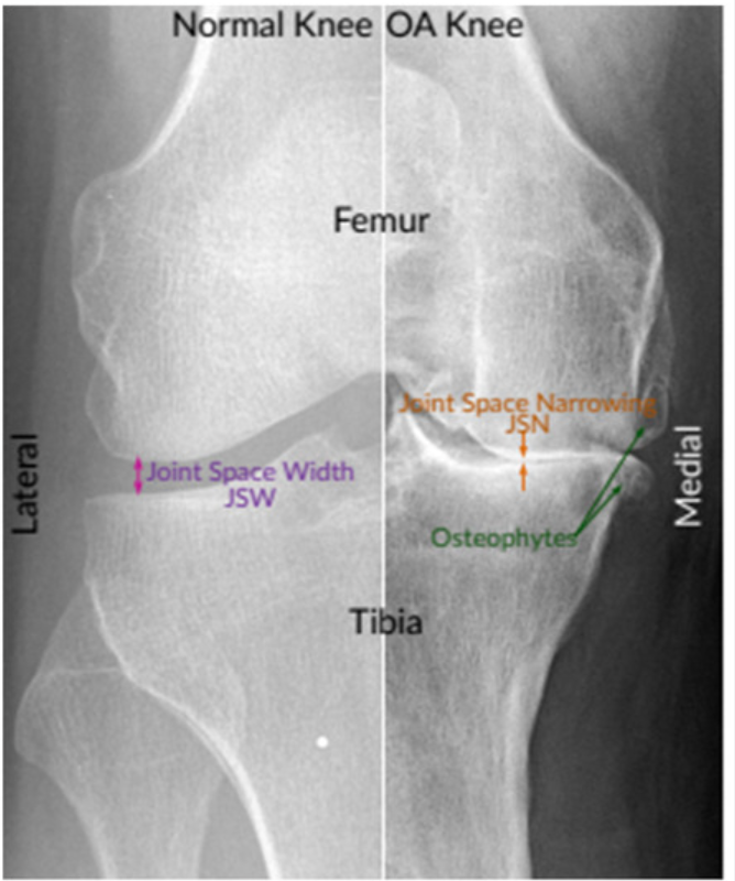 Partial Knee Replacement and Cost-Effectiveness: What a Model Can Tell Us