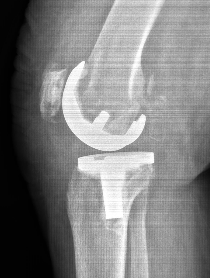 Before Knee Replacement, More Information Is Not Always Better
