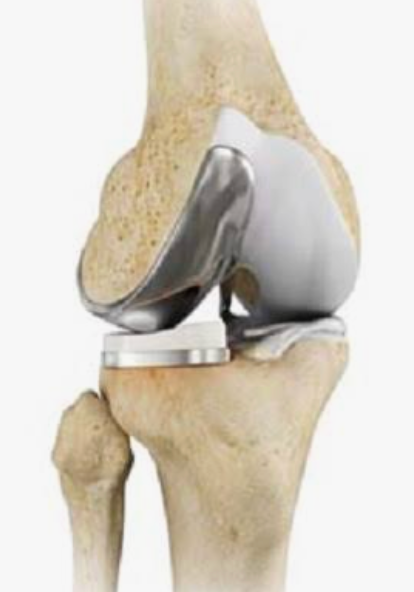 Partial or Total Knee Replacement? What Patients Value Most