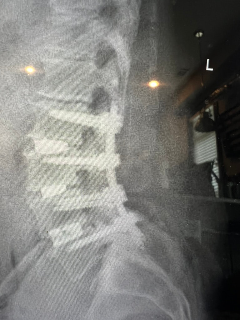 1 cm minimally invasive spine surgery incision by Dr. Joseph Blythe, orthopedic spine surgeon in Oklahoma City — shown next to a pen for scale